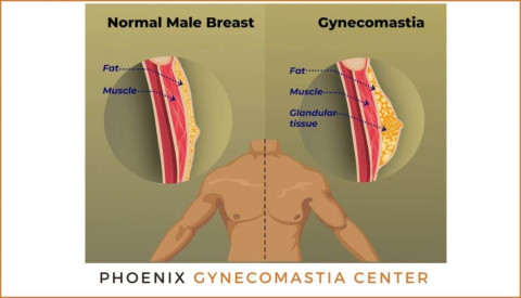 Visit Phoenix Gynecomastia Center